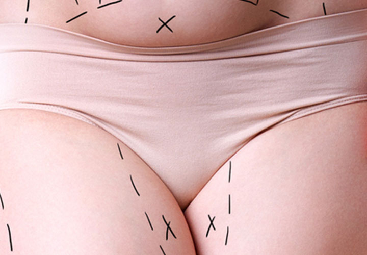 Female liposuction pubic area