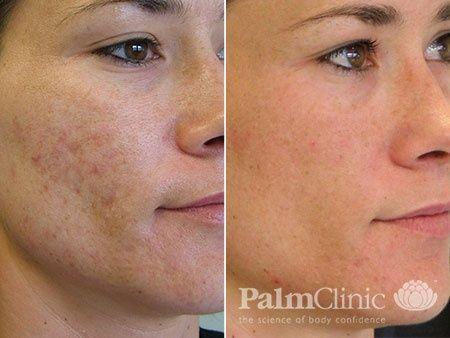 Before and after photo of woman who received microneedling treatment