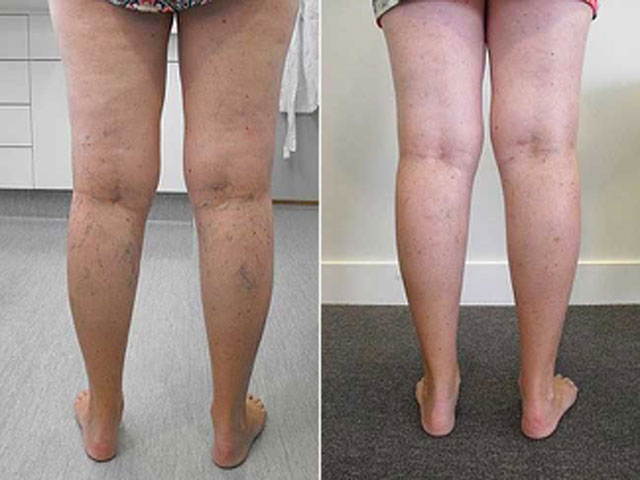 The after photo was taken eight weeks after the patient had four spider vein treatments (microsclerotherapy).