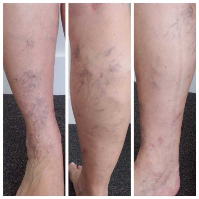 Varicose veins of pregnant woman