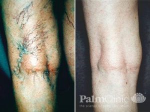 Before and after spider vein treatment