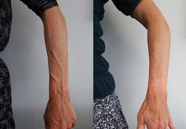 Prominent arm veins.