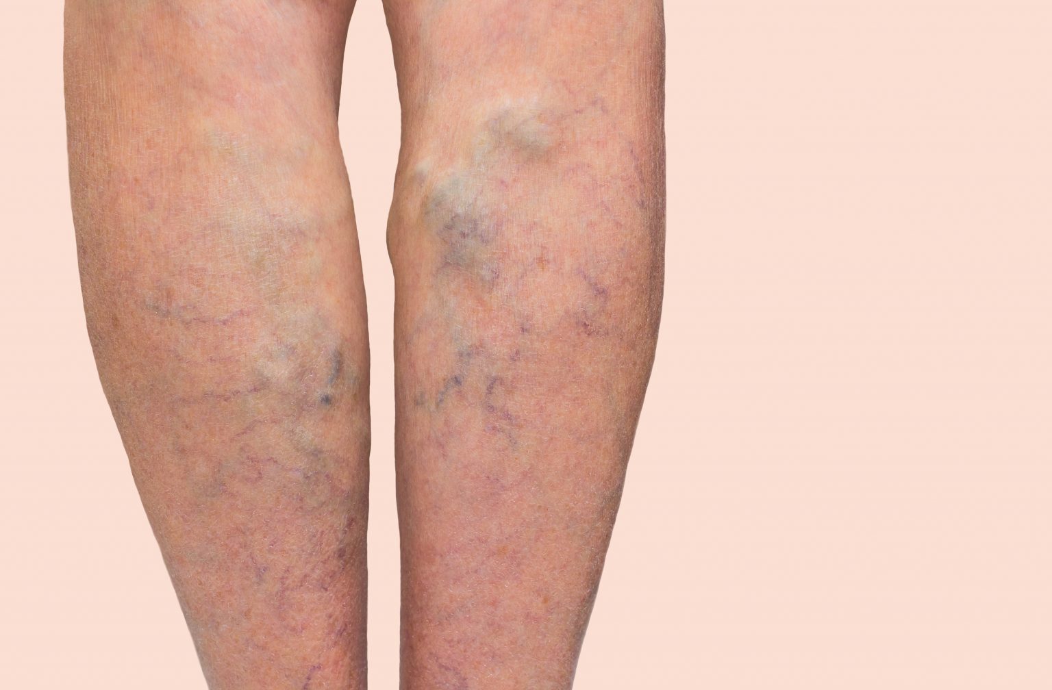 Varicose Veins Causes, Symptoms, Removal & Treatments Auckland NZ