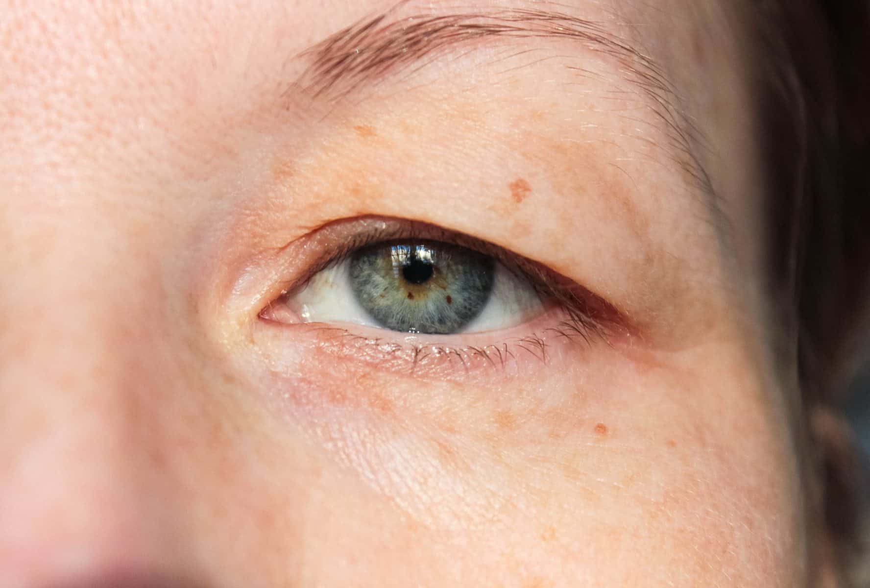 Drooping Eyes Causes, Symptoms and Treatment Auckland NZ Palm Clinic