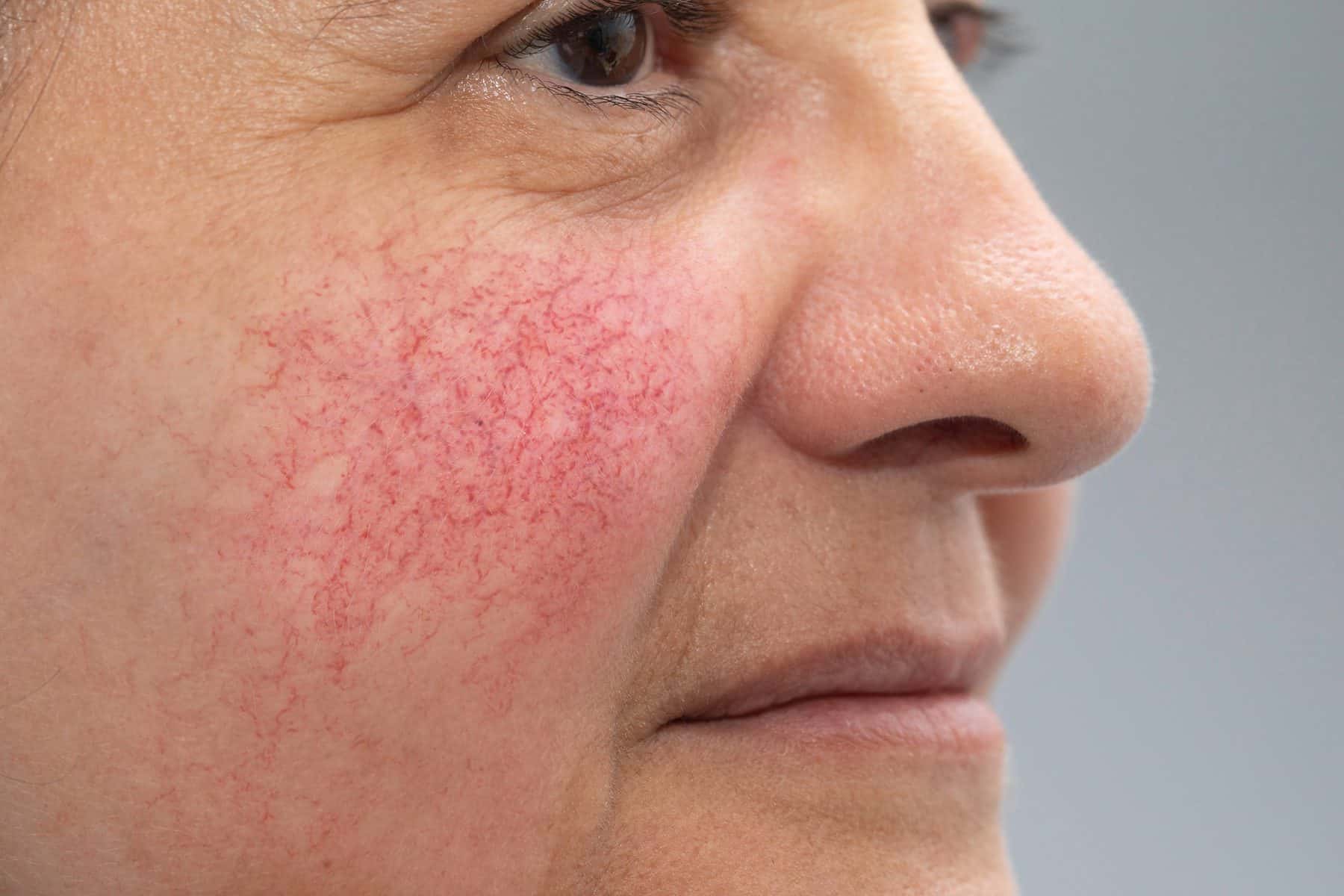 Rosacea And Facial Redness Causes Removal And Treatment Auckland 