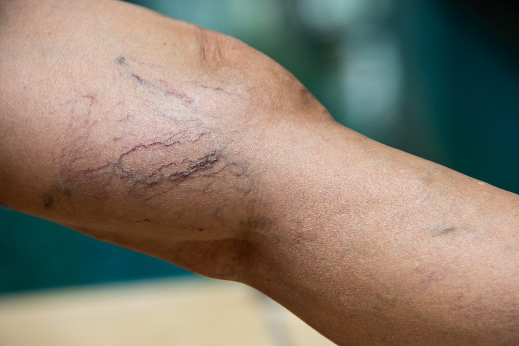 Broken and Spider Veins - Causes, Removal & Treatments - Auckland