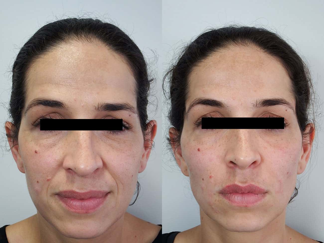 Bags Under Eyes - Causes, Fixes and Surgery Free Treatment - Auckland NZ - Palm Clinic