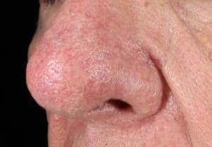 Nose with case of Phymatous Rosacea