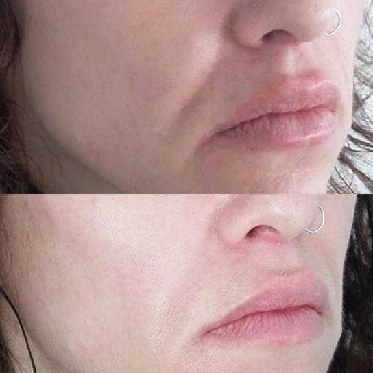 Nasolabial Folds