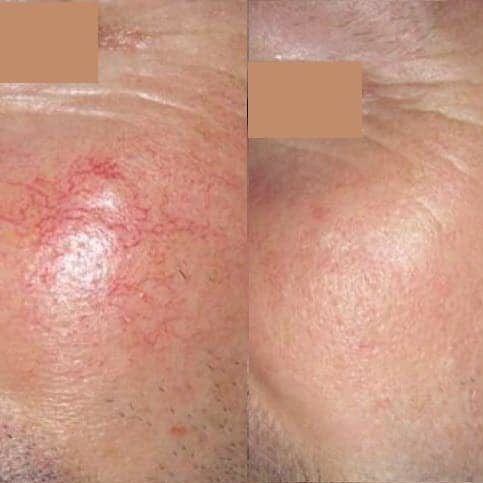 Rosacea / Redness