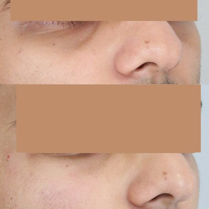 Tear Trough Filler