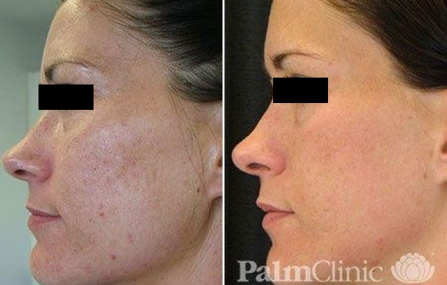 Fraxel Dual Laser has been used to treat acne scarring