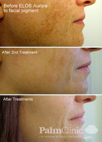 Skin Pigmentation Freckles Melasma Sunspots Causes Removal And Treatment Auckland Nz Palm Clinic