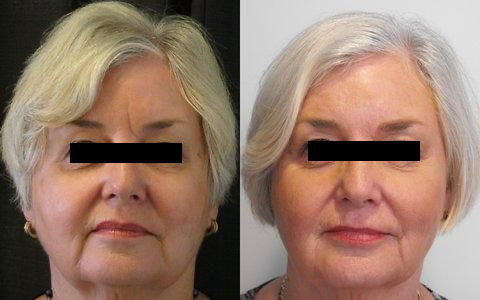 frown lines are best treated by Botox