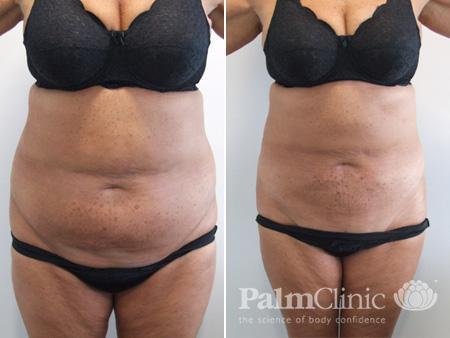 https://palmclinic.co.nz/wp-content/uploads/images/before-after/liposuction/abdomen-00001.jpg