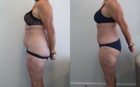 tumescent liposuction achieves good improvement to abdomen and hips