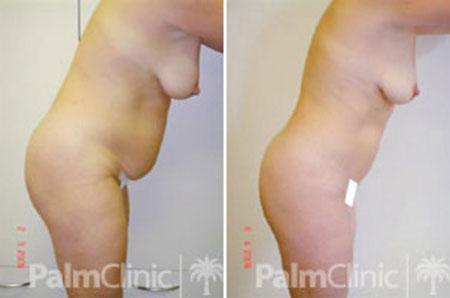 Even when skin elasticity is poor reasonable results can be achieved