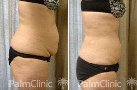 Fantastic result in a 54 year old woman with abdomen, hips and waist liposculpture