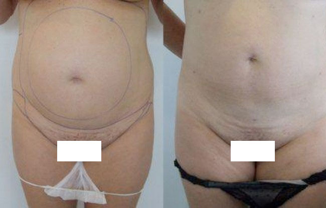 The pubic area has been treated with liposculpture at the same time as the abdomen
