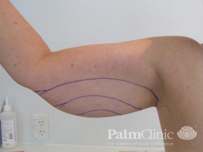 lower arm liposuction