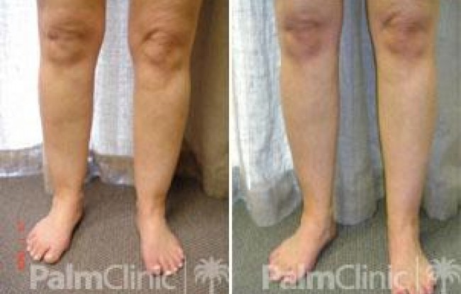 Finer ankles with liposculpture
