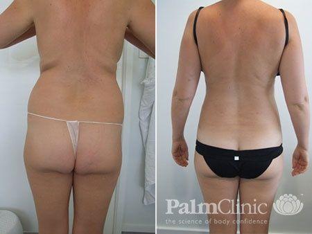 Flanks Liposuction  Before and After Photos - Palm Clinic