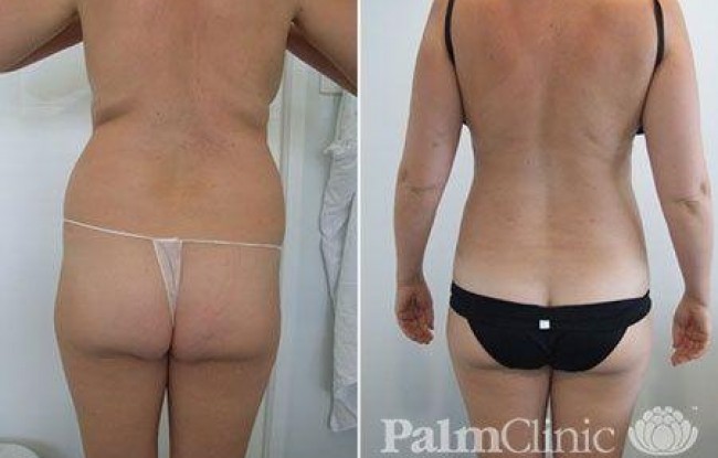 treat hips, waist and under bra area with liposuction to give a more feminine and youthful outline