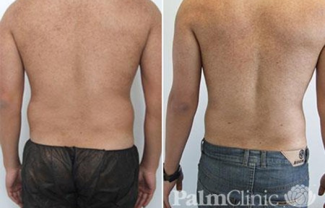 Liposuction for Men Before & After Photo Gallery