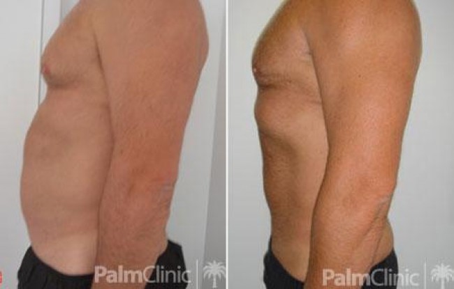 Before and after photos of male abdomen and chest liposuction