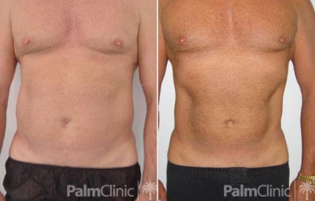 Liposuction performed under tumescent anaesthesia has been used to sculpture the chest and abdomen
