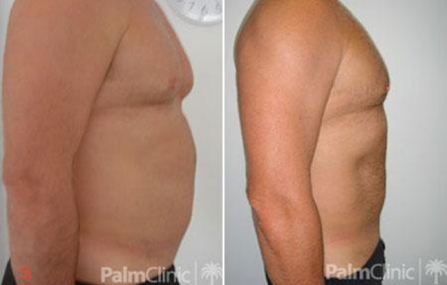 before and after photo demonstrates improvements with liposuction to chest and abdomen