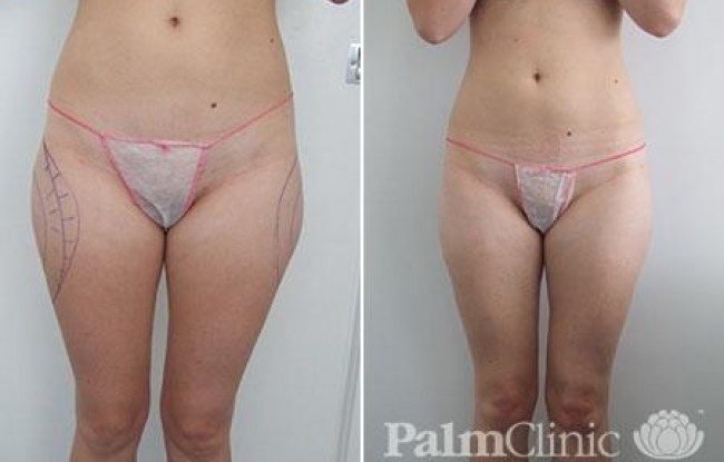 Thighs Liposuction  Before and After Photos - Palm Clinic