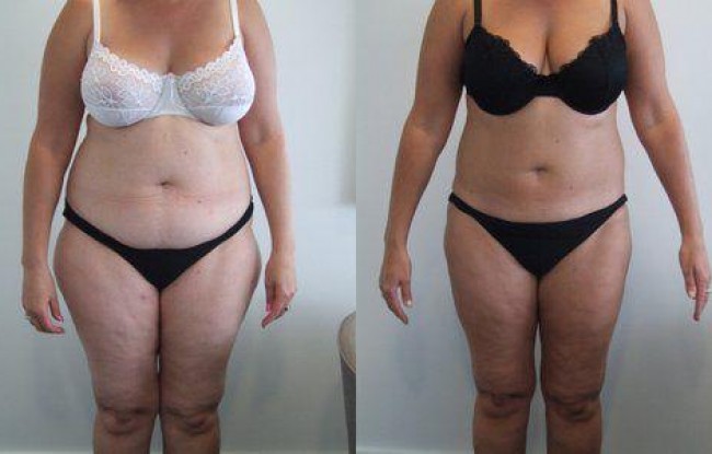 Thighs Liposuction  Before and After Photos - Palm Clinic
