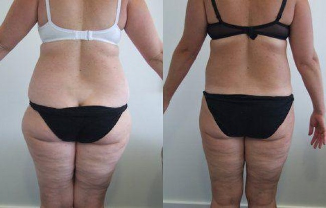 The inner and outer thighs have been treated with liposculpture along with the hips and inner knees