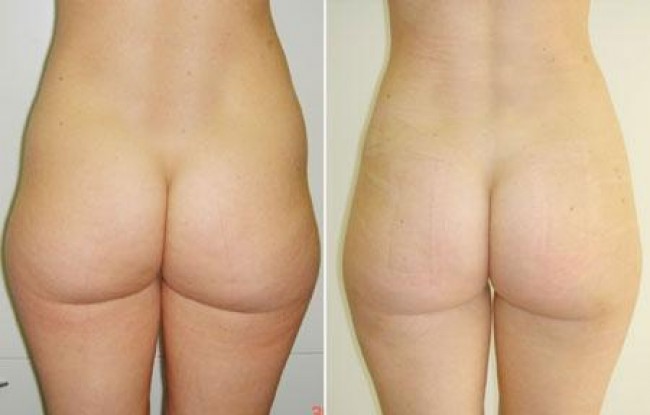 In this patient I have treated her hips and outer thighs to remove the "double bubble"