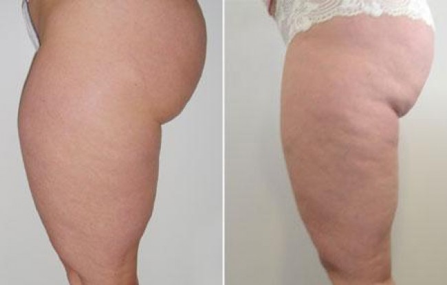 Front of thighs reduced with liposuction