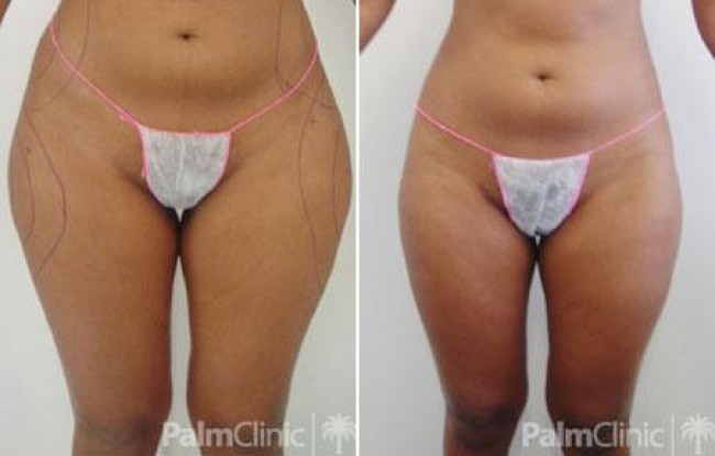 achieved by combining liposuction to the hips and outer thighs