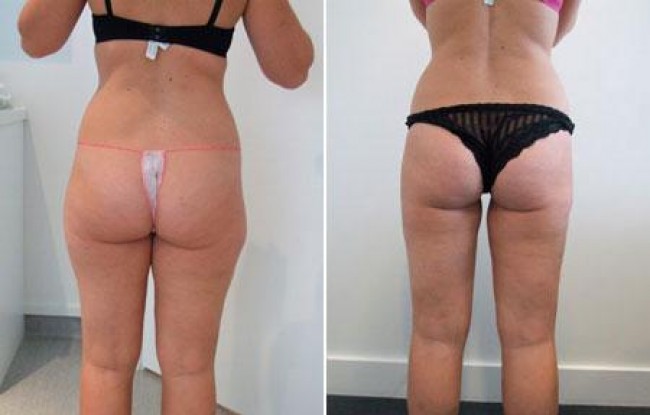 Thigh liposuction before and after photos