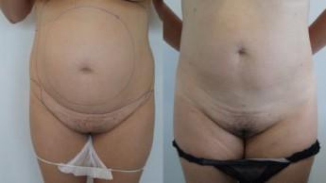 public liposuction results may vary