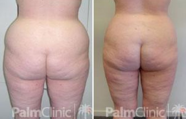 waist improved by treating the hip area and flanks and typically involves liposuction of the abdomen as well