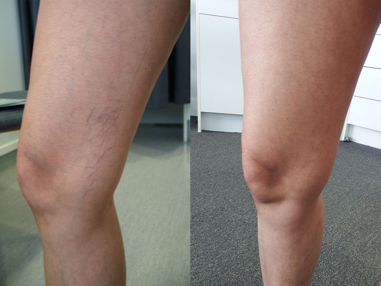 Spider Vein Removal Before And After Photos Palm Clinic