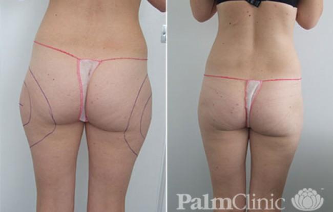 Liposuction for buttocks