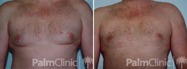 Liposuction for men's chest