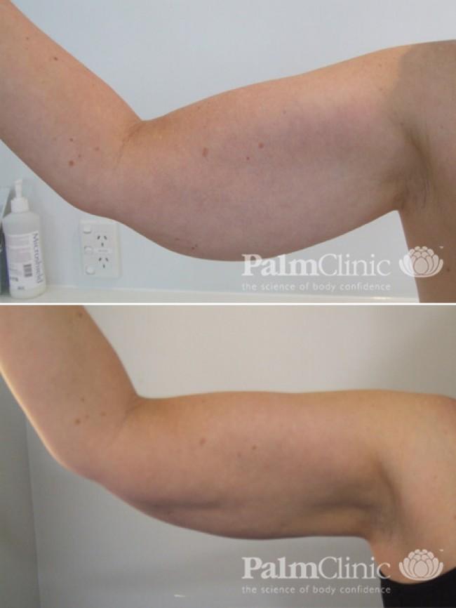 Liposuction for arms