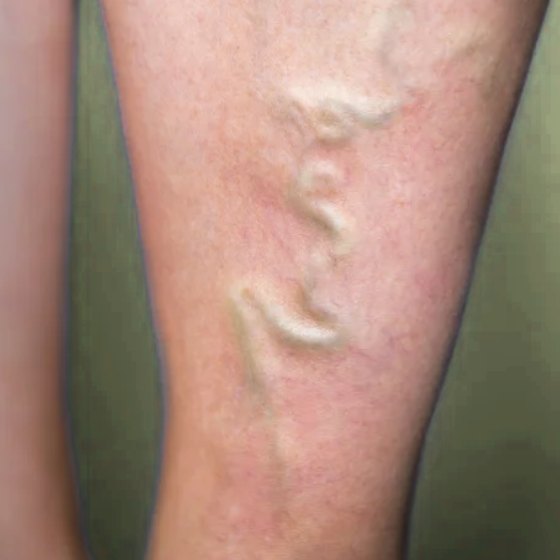 Varicose veins