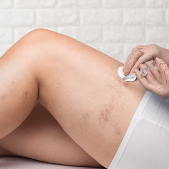 Vein treatment