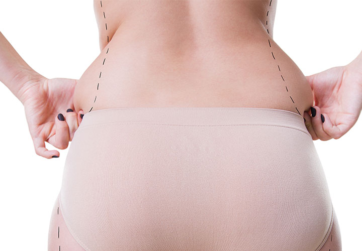 Hips Liposuction