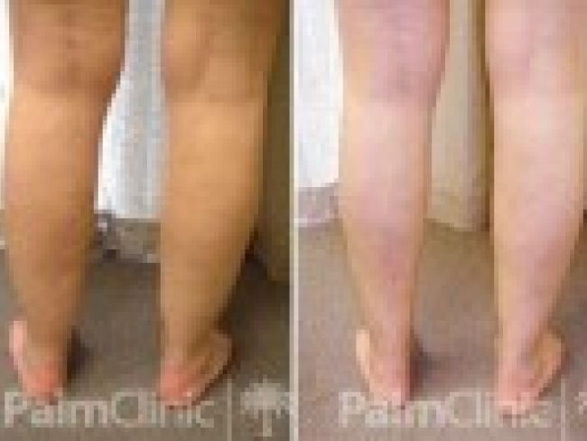 Cankles